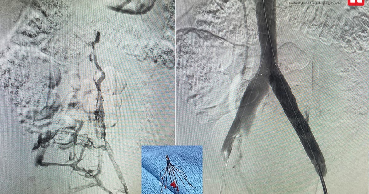مستشفى الدكتور سليمان الحبيب بالفيحاء في جدة يُنهي معاناة أربعينية” مع متلازمة May-Thurner المسببة للجلطات